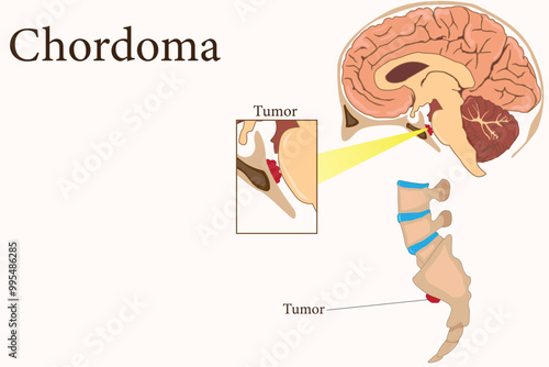 Chordoma is a rare malignant tumor originating from notochordal remnants, primarily affecting the spine. Chordoma tumor in the coccyx and skull. eps 10