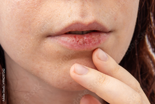 Dry skin on face and dry chapped lips. Cracked female lips