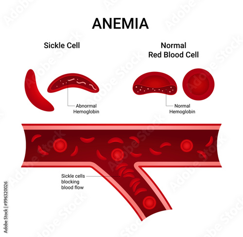 Shape of Sickle Cell with Abnormal Hemoglobin