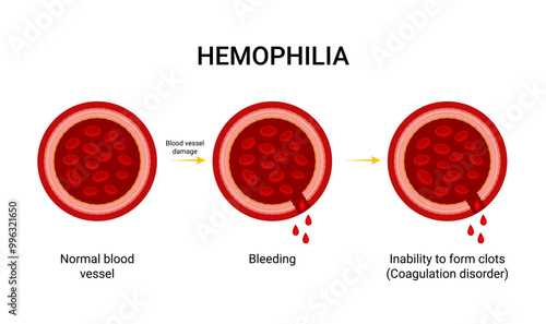 Overview of Hemophilia Cause Diagram