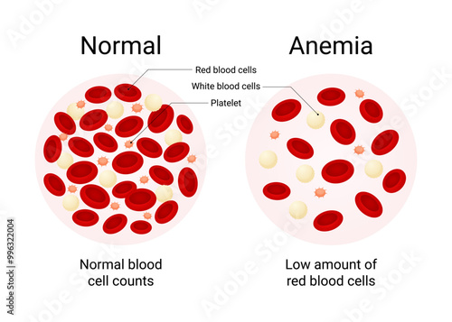 Overview of Normal Blood and Anemia