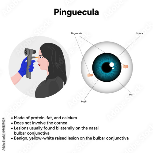 Ophthalmology. Pinguecula information and infographic 