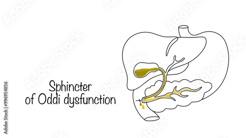 Sphincter of Oddi dysfunction