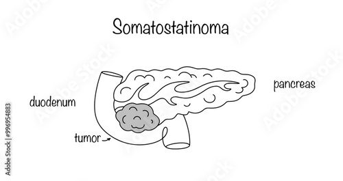 Somatostatinoma