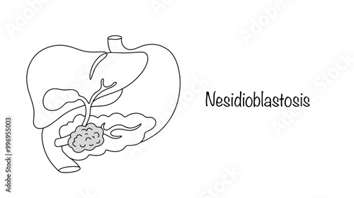 Nesidioblastosis photo