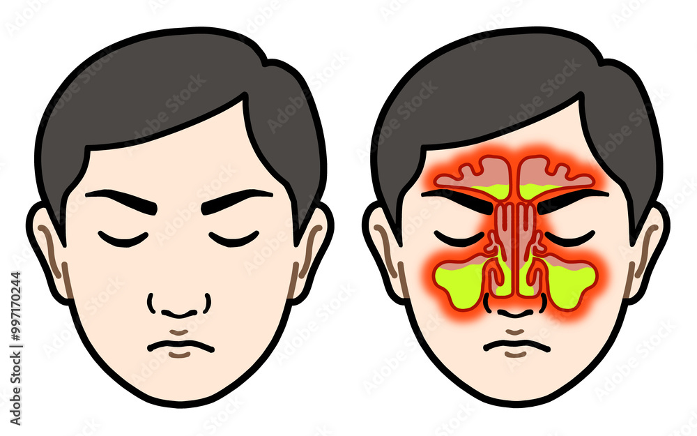 副鼻腔炎 男性 副鼻腔炎 男性