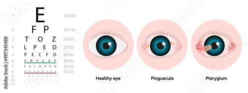 Optometry appointment healthy eye pinguecula and pterygium