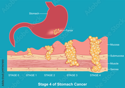 Stage 4 of Stomach(gastric)cancer.