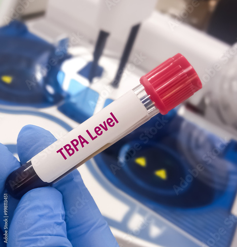 Blood sample for Thyroxine-binding prealbumin (TBPA), thyroid function tests or thyroid panel test (T3,T4,TSH,FT3,FT4) to diagnosis of hyperthyroidism or hypothyroidism. photo