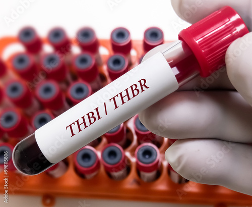 Blood sample for Thyroid Hormone–Binding Ratio (THBR) or THBI or T3 resin uptake(T3RU) test. Thyroid function tests to diagnosis of hyperthyroidism or hypothyroidism of a patient.