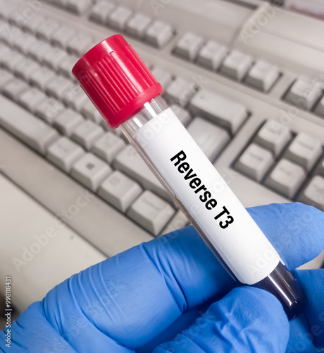 Blood sample for Reverse T3 (rT3) test. It's a byproduct of thyroid hormone metabolism. Thyroid function tests to diagnosis of hyperthyroidism or hypothyroidism of a patient.