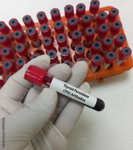 Blood sample for Thyroid Peroxidase Antibodies or Anti-TPO test and anti-Tg Test. Thyroid function tests, to diagnosis of hypothyroidism and thyroiditis. photo