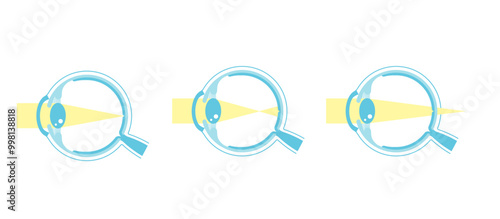 Vector illustration of normal vision and myopia and hyperopia.