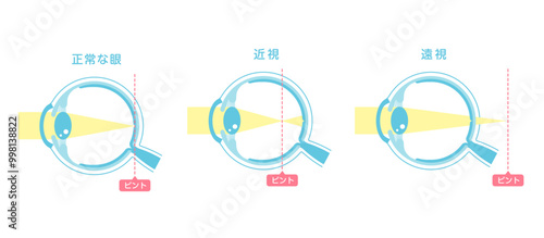 正常な眼と近視・遠視のピント位置 ベクターイラスト