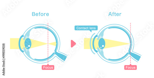 Illustration comparing vision before and after wearing contact lens