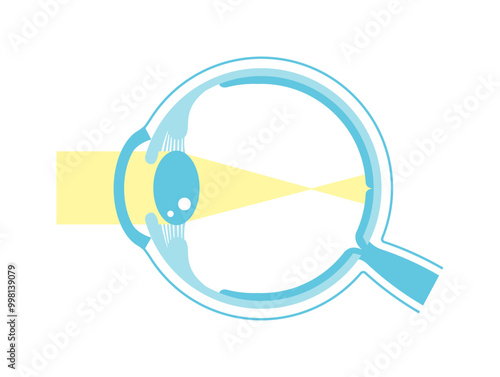Vector illustration of myopia (no text)
