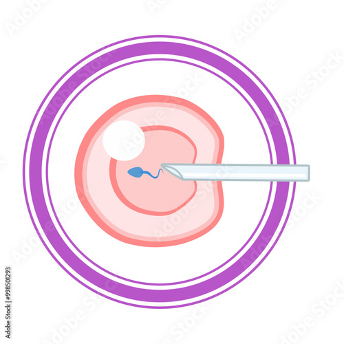 In Vitro fertilization IVF vector infographic and infertility treatment scheme with purple line artificial insemination, embryo culture and cryopreservation. Medical procedure for pregnancy