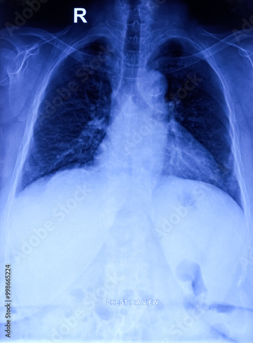 Film x-ray chest PA or CXR (PA view). photo