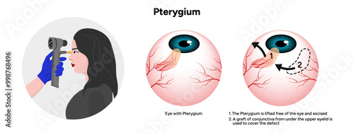 Pterygium eye disease lifted free of the eye and excised optometry appointment 