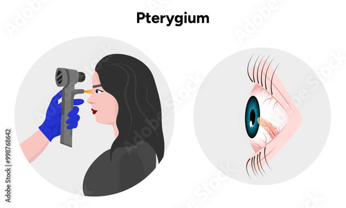 Pterygium eye disease optometry appointment 