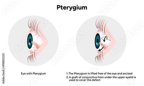 Pterygium eye disease lifted free of the eye and excised optometry appointment 