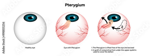 Pterygium eye disease lifted free of the eye and excised optometry appointment 