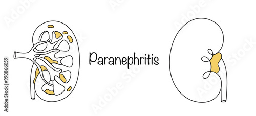 Paranephritis