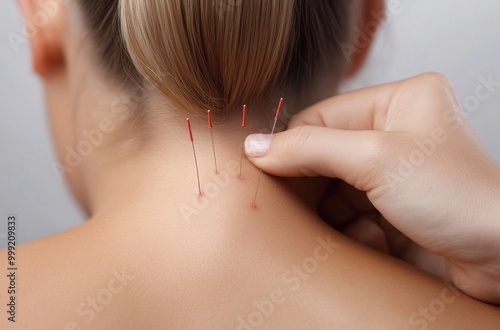 Holistic wellness: ancient practice of acupuncture, delicate placement of needles on the human body, emphasizing balance, healing, and the therapeutic benefits of this traditional method.