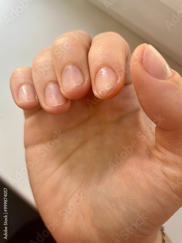 Photo of women's nails, brittle and damaged after gel polish.