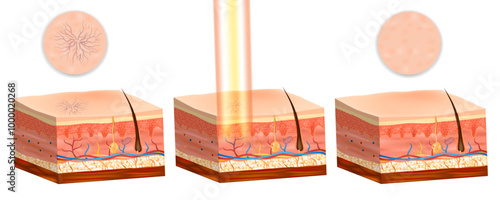 Laser Treatment for Telangiectasias and reticular veins. Before and  after treatment