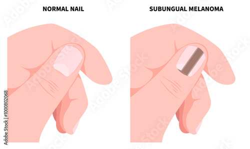 Subungual melanoma or Nail cancer with discolored line that appears brown or black