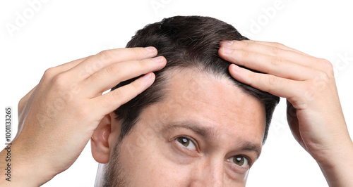 Man with hair loss problem on white background