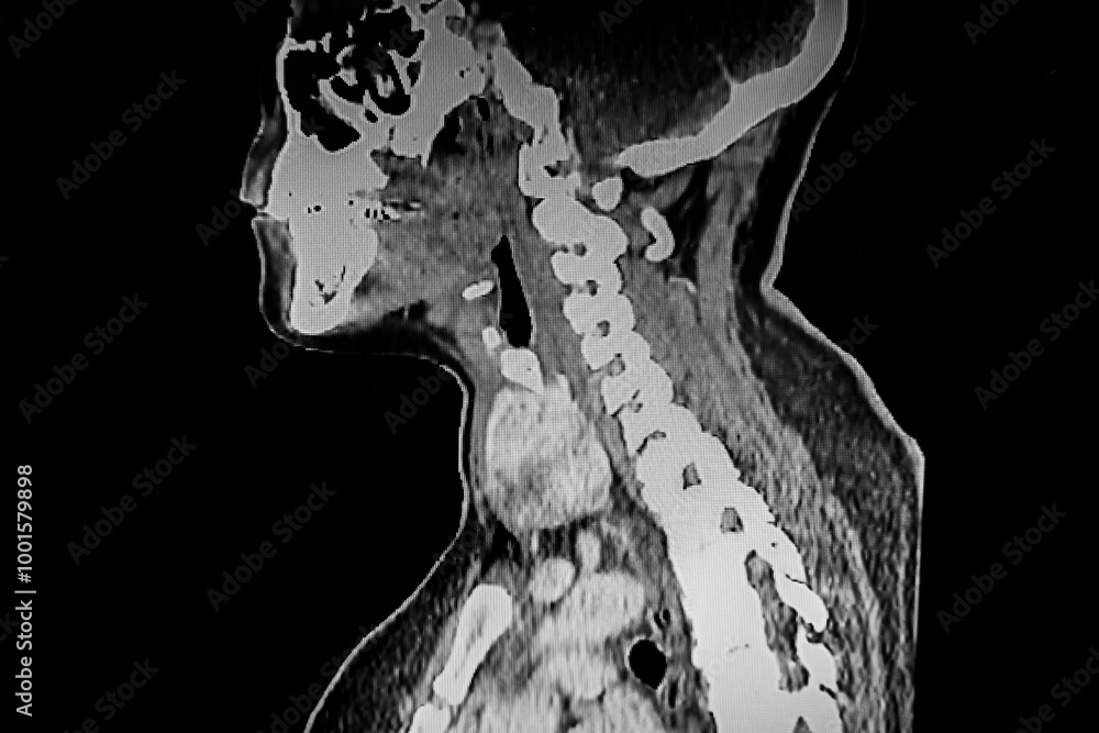 Medial themes: CAT Scan of 4 cm thyroid nodule that occupies the left lobe.