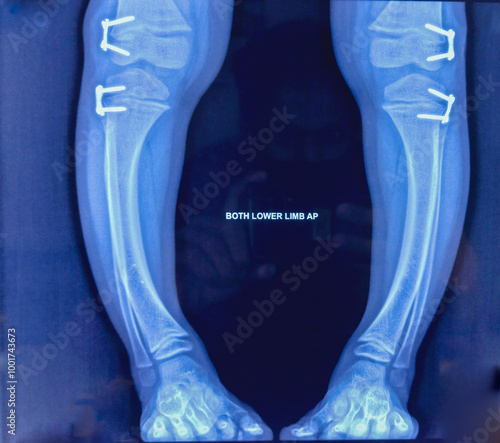 Tableau sur toile X-ray of both legs, thigh view