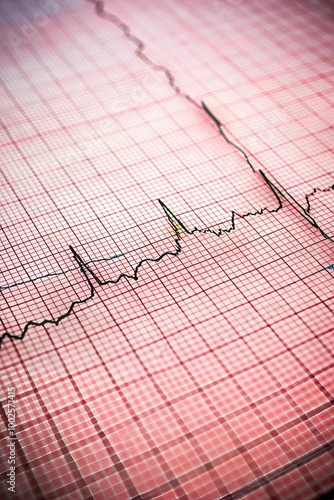 EKG arrhythmia absoluta, printout background