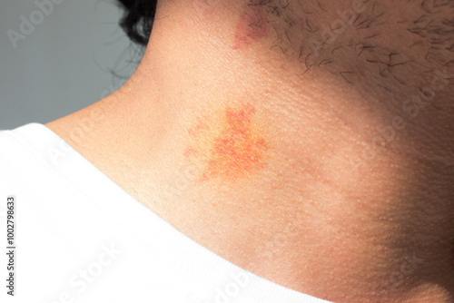 Photographs of a person with bruises on the neck (hickey). 