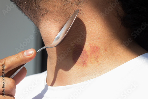 Picture of spoon healing a hickey on a person's neck. photo