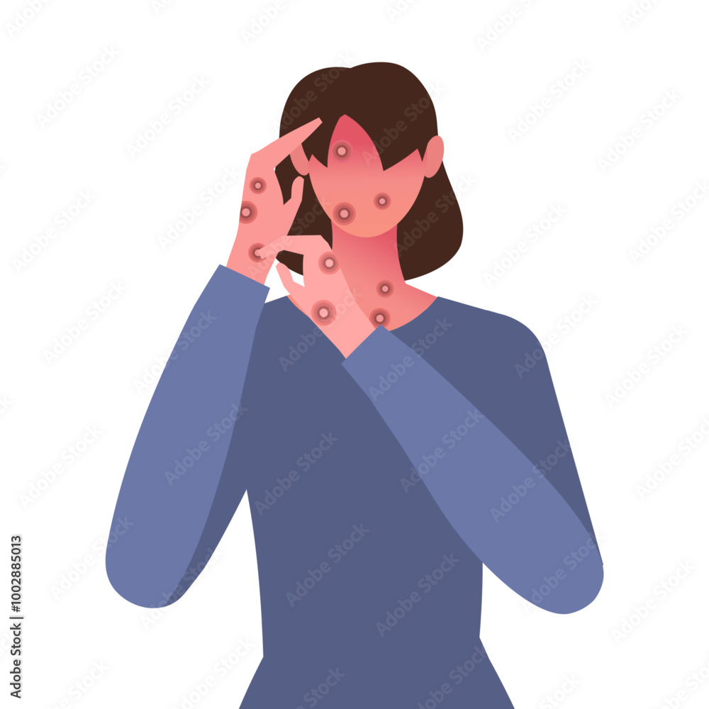 Monkeypox virus. Woman with with rashes on face, body and back, one of Monkeypox symptom. Fever, headache, swollen lymph node, muscle aches. Flat vector illustration. Not AI generated Monkeypox virus. Woman with with rashes on face, body and back, one of Monkeypox symptom. Fever, headache, swollen lymph node, muscle aches. Flat vector illustration. Not AI generated