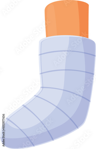 Blue plaster cast is covering injured leg after fracture, providing support and immobilization during healing process