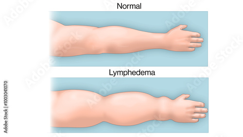 Normal Hand vs Lymphedema Hand: Comparative Anatomy and Pathology