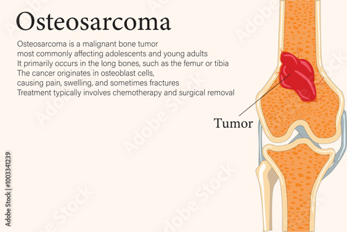 Split bone revealing an osteosarcoma tumor inside, highlighting malignant growth and bone pathology. with  description text. eps 10