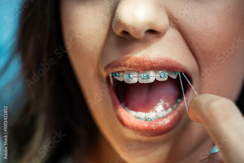 Frontal closeup shot, young woman putting rubber band on dental brackets with her finger photo