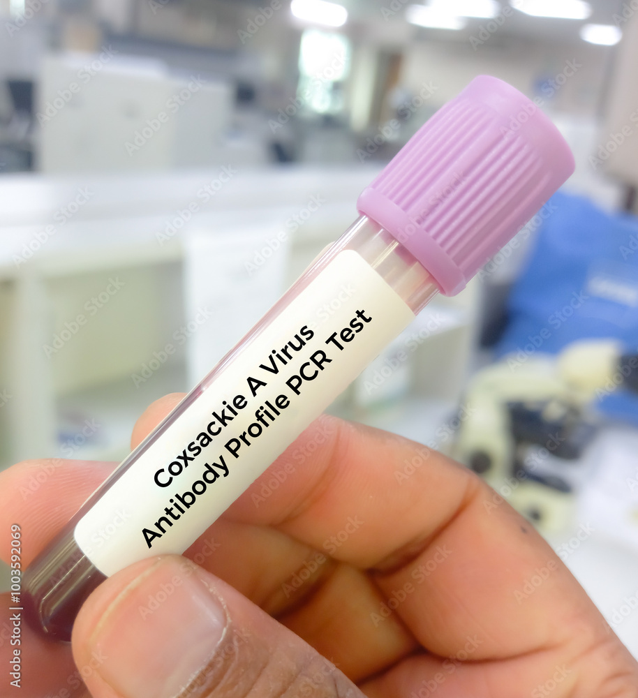 Blood sample for Hand foot and mouth disease (HFMD) test. It is a highly contagious infection. It's caused by viruses from the Enterovirus genus, most commonly the coxsackievirus. Blood sample for Hand foot and mouth disease (HFMD) test. It is a highly contagious infection. It's caused by viruses from the Enterovirus genus, most commonly the coxsackievirus.