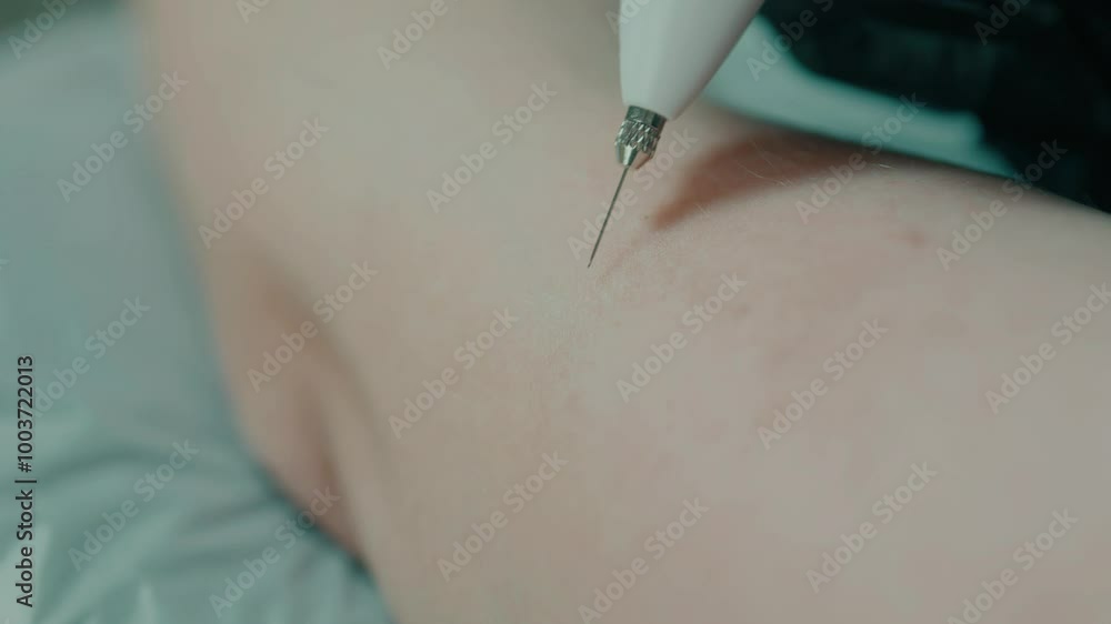Cosmetologist's hands in black gloves using Laser Plasma Pen on patient's skin. Cosmetologist's hands in black gloves using Laser Plasma Pen on patient's skin.
