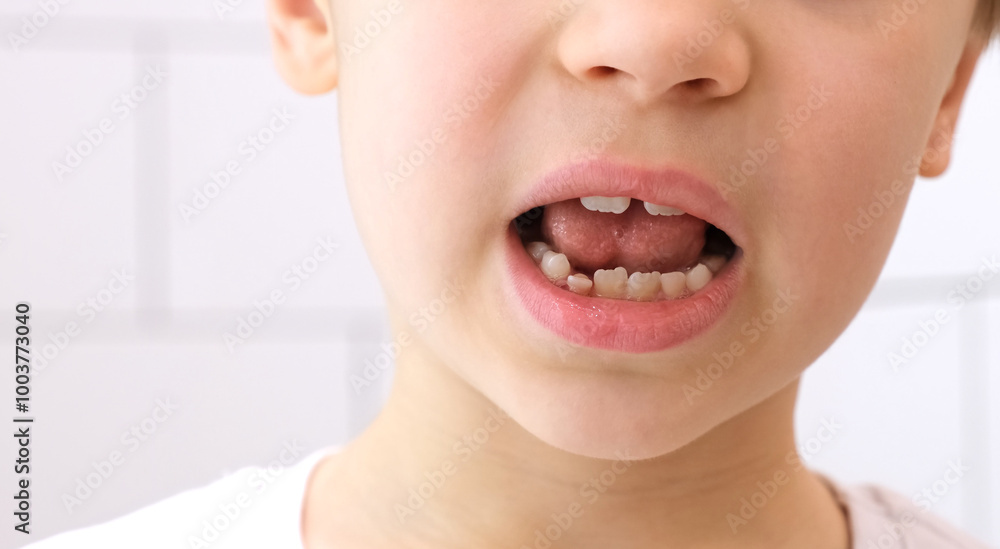 Fototapeta premium Child shows his loose milk tooth presses and pushes it with his tongue. Open mouth close-up. Caucasian 6 year old kid in a white T-shirt on a bathroom background. lower incisor. Copy space. Body part