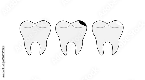 three teeth set of healthy caries and with a filling on a white background
