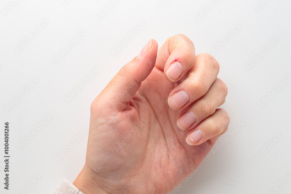 Closeup of hand with deformed nails and torn, ripped and picked on cuticle skin peeling off from human nail biting behavior Closeup of hand with deformed nails and torn, ripped and picked on cuticle skin peeling off from human nail biting behavior