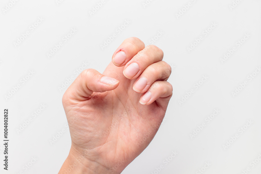 Closeup of hand with deformed nails and torn, ripped and picked on cuticle skin peeling off from human nail biting behavior Closeup of hand with deformed nails and torn, ripped and picked on cuticle skin peeling off from human nail biting behavior