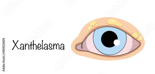 Xanthelasma