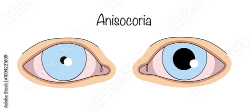 Anisocoria